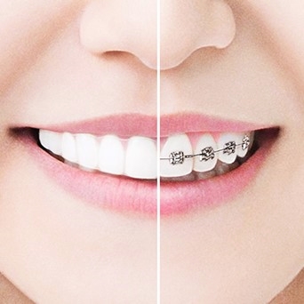 目立たないマウスピース矯正